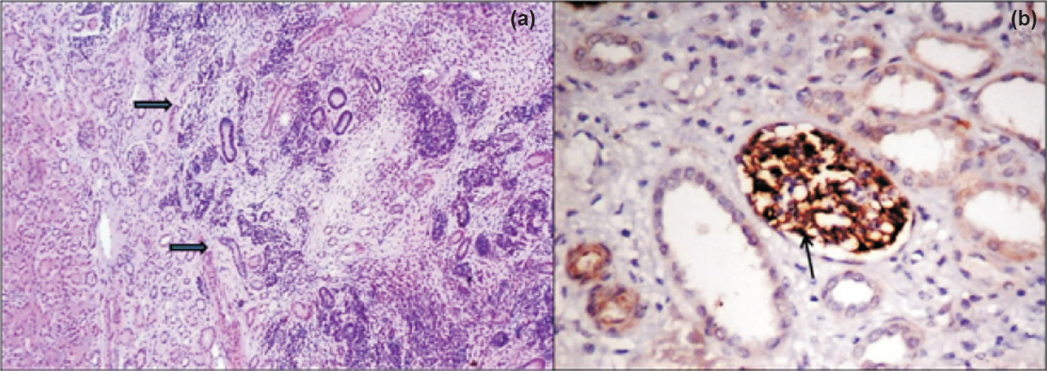 (a). Microphotograph of intralobar nephrogenic rest (ILNR) comprising blastema, tubules and stromal components (H&E x100). (b) WT1 immunostaining in normal kidney - strong positive WT1 immunoexpression in glomerular podocytes (arrow) and faint cytoplasmic staining in the tubules (Immunostain x400).